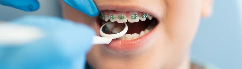 今以上の見栄えと土台づくりのために ~小児矯正~